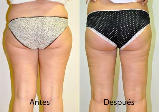 Liposucción, antes y después