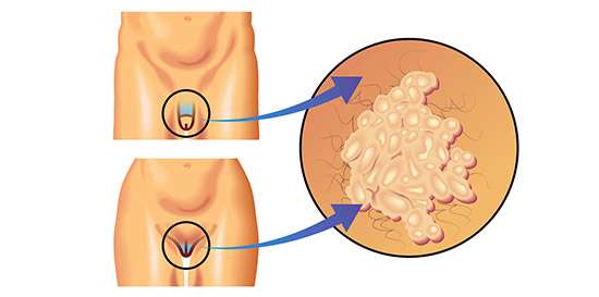 verrugas genitales vph hombres