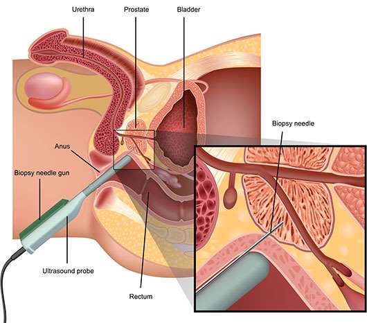 biopsia de próstata procedimiento