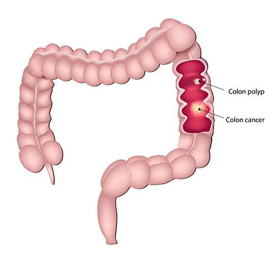Cancer / Pólipo colón recto