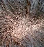 Alopecia o pérdida de cabello: ¿cuál es el mejor tratamiento?