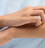 ¿Qué es la dermatitis atópica y cuáles son sus causas?