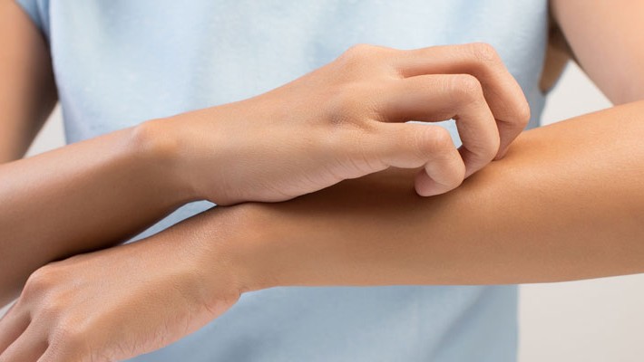 ¿Qué es la Dermatitis atópica?