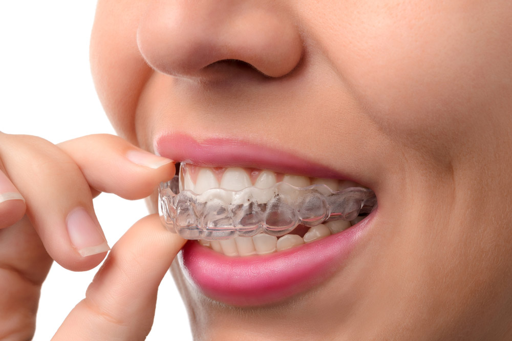 Invisalign - Ortodoncia Invisible