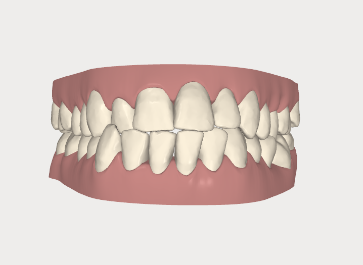 Invisalign - Captura 3D