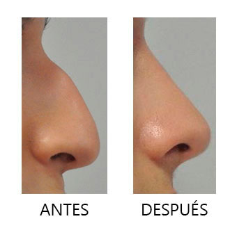 Rinoplastia | Antes y después