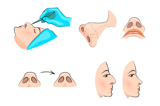 Diagrama rinoplastia