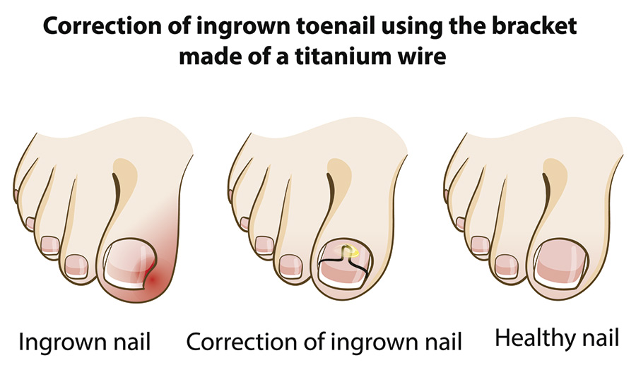 9 Formas efectivas de arreglar las uñas encarnadas en los dedos de los pies   Genial
