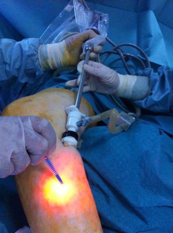varicoza la laparoscopie