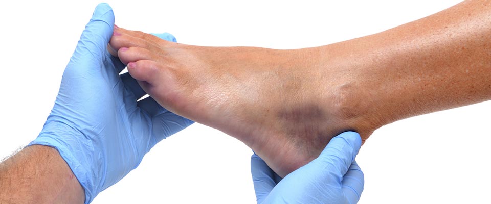 umflai piciorul în varicoza tratamentul venelor superficiale ale venelor