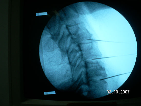 Tratamiento cervicalgias