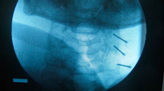 Radiografía tratamiento lesiones cervicales