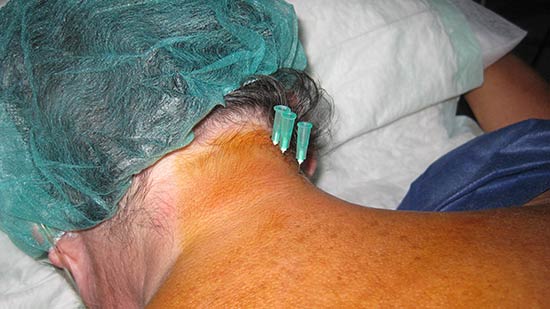 Tratamiento lesión cervical