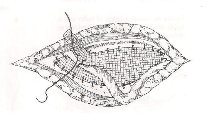 malla-hernias