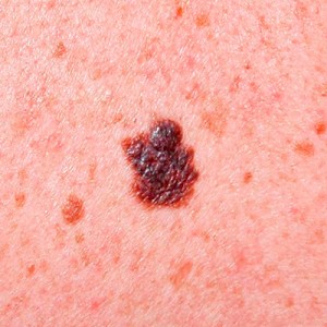 Melanoma Piel