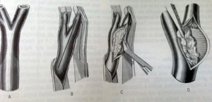 tratamiento-ictus