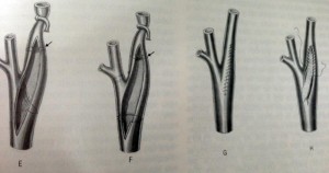 tratamiento-ictus-cerebral