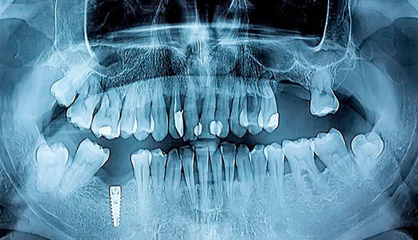 implantes dentales