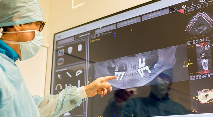 Implantes inmediatos: recupera tu sonrisa en 24 horas