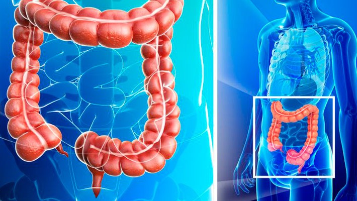 Síntomas y diagnóstico del cáncer intestinal