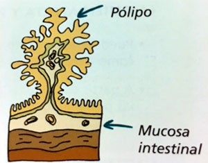 polipo-cancer-colon
