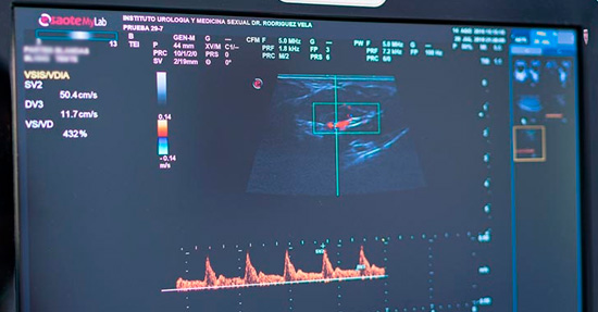 ¿Cuándo es necesario operar el varicocele?