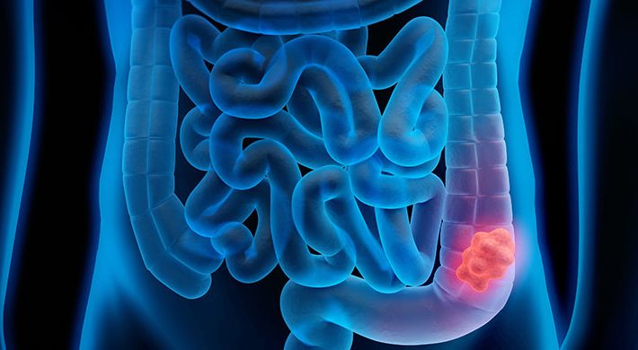 Diagnóstico y tratamiento del cáncer de colon: el cáncer digestivo más frecuente