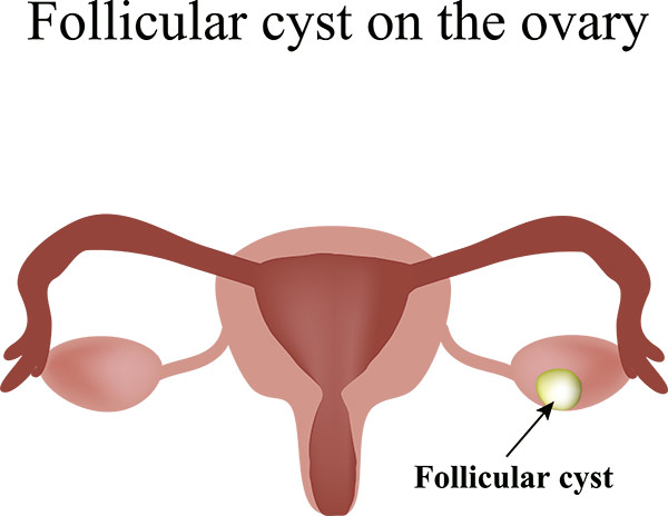 quiste ovario