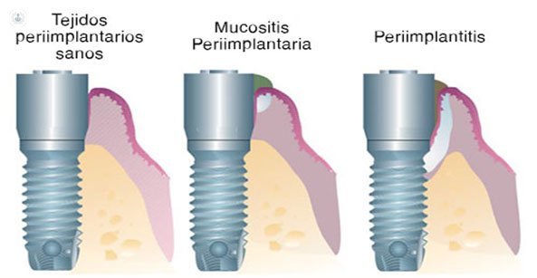 mucositis-periimplantitis