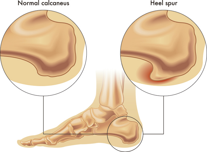 Fascitis plantar y espolón 