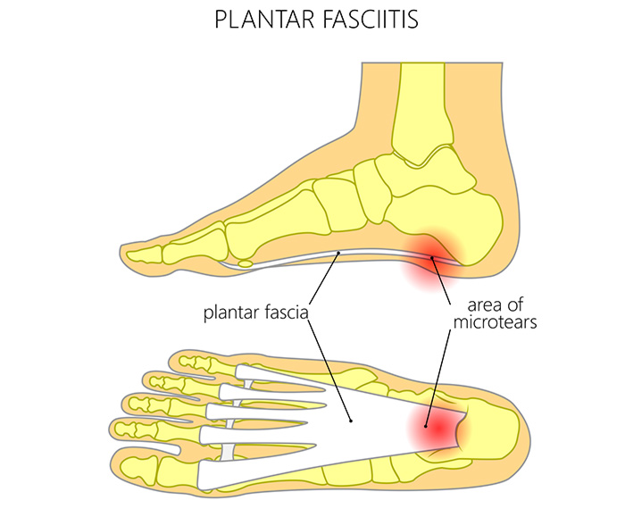 Fascitis plantar, espolones y edema óseo: ¿Cómo aliviar el dolor?