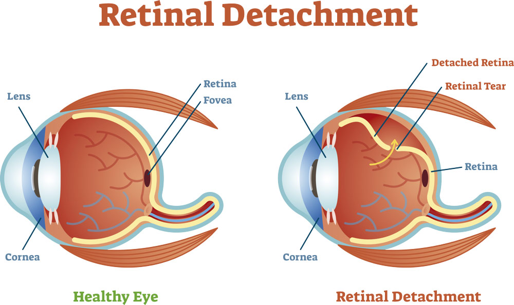 causas-desprendimiento-retina