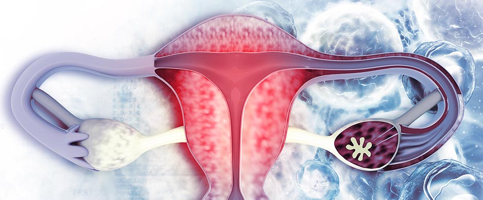qué es el síndrome de ovario poliquístico