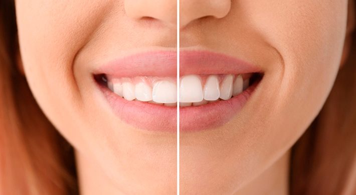 Tratamientos más comunes de estética dental