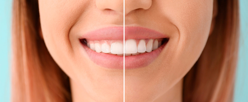 Comparativa de la sonrisa de una paciente antes y después de haber recibido un tratamiento de estética dental.