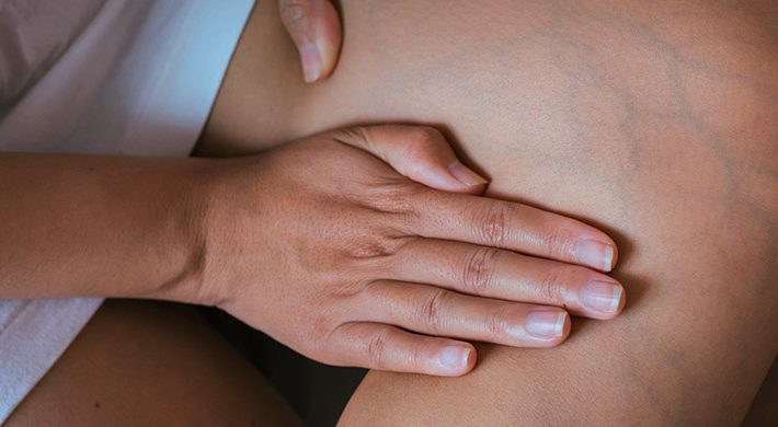 Cómo reducir los síntomas de las varices en las piernas