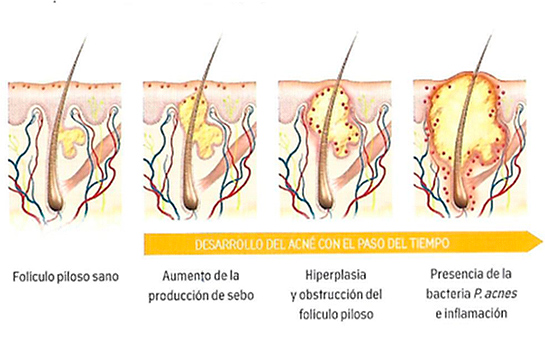 Grados de acné