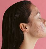 Los tipos de acné: ¿cuáles hay y cómo se tratan?