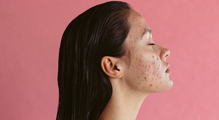 Los tipos de acné: ¿cuáles hay y cómo se tratan?