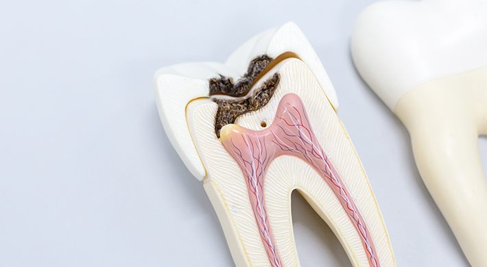 Endodoncia: ¿duele realmente este tratamiento?