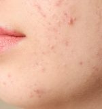 La importancia de una alimentación equilibrada en el tratamiento y prevención del acné