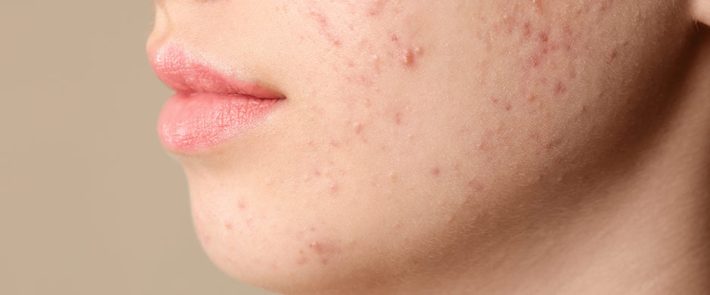 Una alimentación equilibrada puede prevenir el acné | Doctología