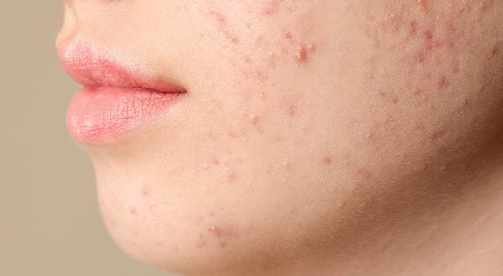 La importancia de una alimentación equilibrada en el tratamiento y prevención del acné