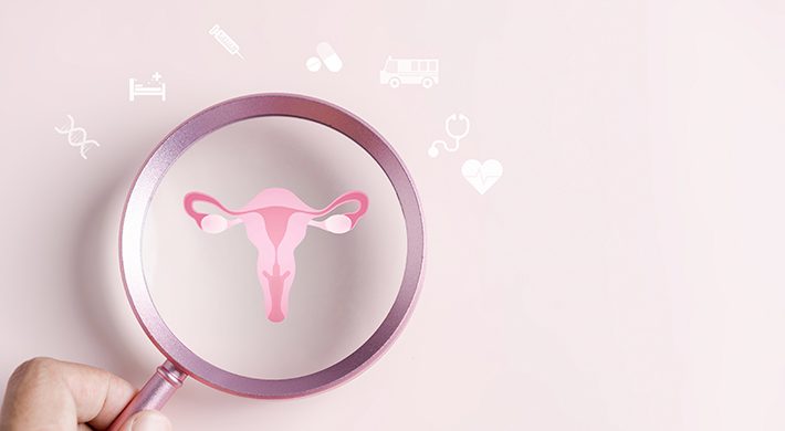 Síndrome del Ovario Poliquístico: causas, síntomas y tratamiento