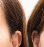 Tratamientos antiojeras: tipos y prevención