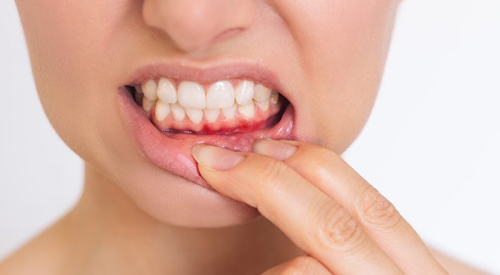 ¿Qué es la periodoncia? Tratamientos para las encías