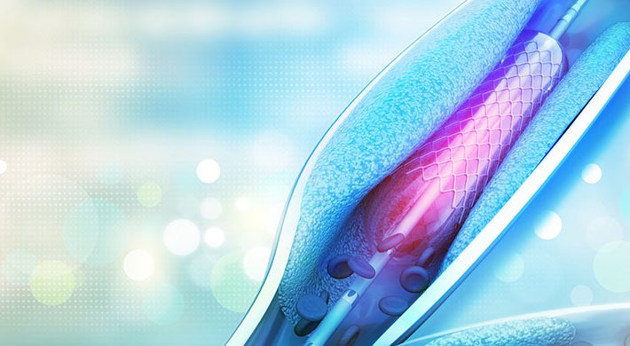 Tratamientos endovasculares, ¿qué son y para qué casos se recomiendan?