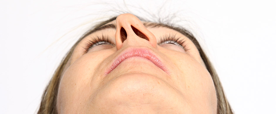 septoplastia mujer con nariz desviada