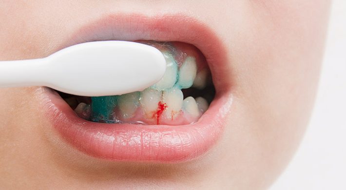 ¿Es malo cepillarse mucho los dientes?