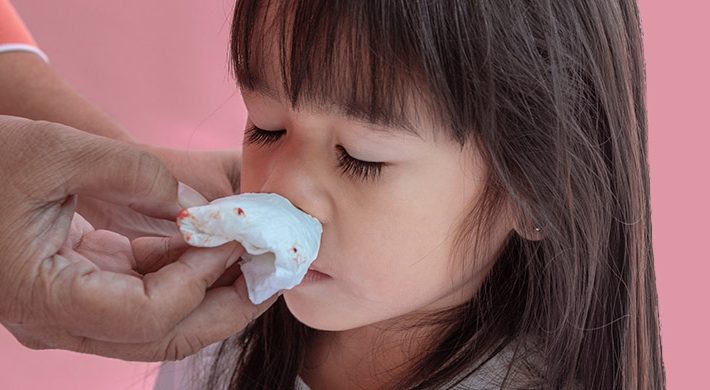 Epistaxis: causas y tratamiento de la hemorragia nasal